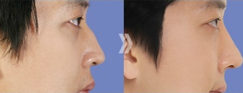 有哪些矫正驼峰鼻的手术方法呢？