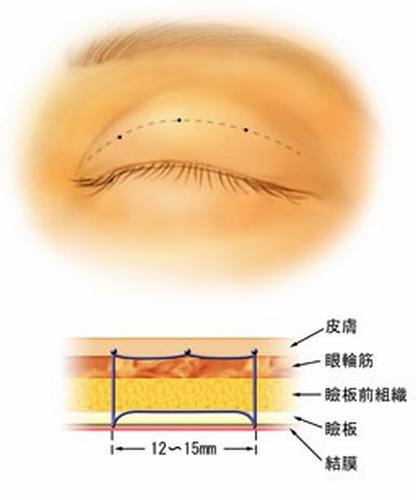 双眼皮术后什么时候冰敷?什么时候热敷?