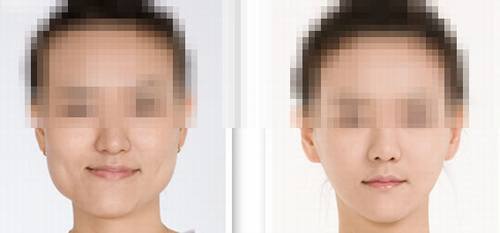 北京圣嘉新整形医院张笑天下颌角磨骨好不好?多少钱?