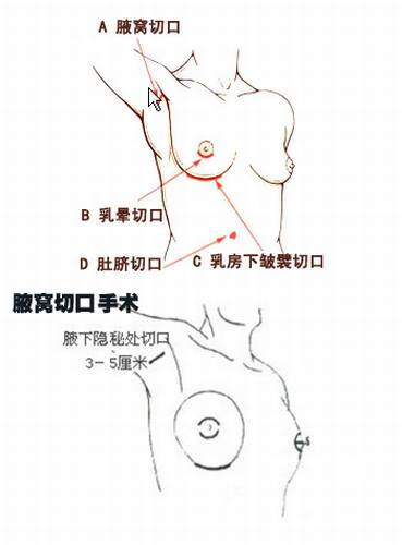 北京八大处刘春军做假体隆胸怎么样？有案例吗？