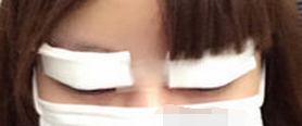 上海百达丽王维做双眼皮修复怎么样？多少钱？