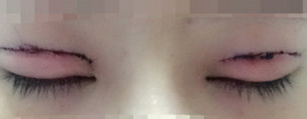 上海百达丽王维做双眼皮修复怎么样?多少钱?