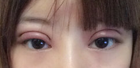 上海百达丽王维做双眼皮修复怎么样？多少钱？