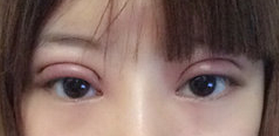 上海百达丽王维做双眼皮修复怎么样?多少钱?