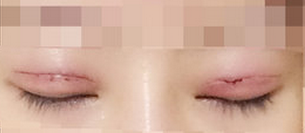 上海百达丽王维做双眼皮修复怎么样?多少钱?