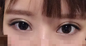 上海百达丽王维做双眼皮修复怎么样?多少钱?