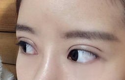 上海百达丽王维做双眼皮修复怎么样?多少钱?