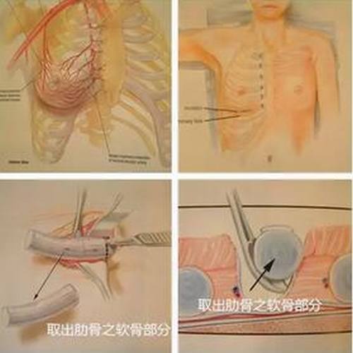 讲解,什么是肋软骨隆鼻