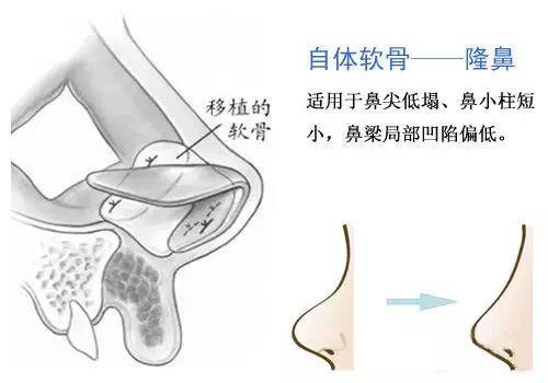 讲解，什么是肋软骨隆鼻