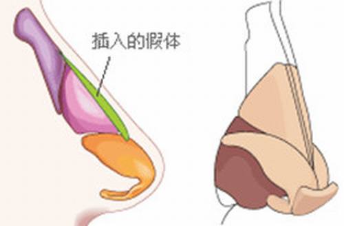 巫文云解说膨体隆鼻垫下巴真的容易感染吗?