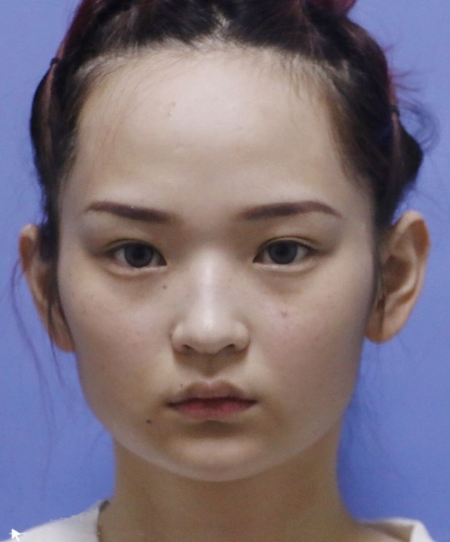 磨骨完后我后悔了,你们是不知道磨骨削骨后对一个人的改变有多大!