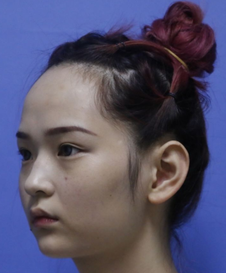 磨骨完后我后悔了,你们是不知道磨骨削骨后对一个人的改变有多大!