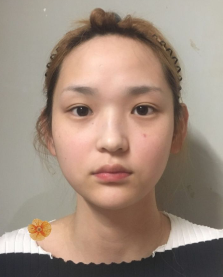 磨骨完后我后悔了,你们是不知道磨骨削骨后对一个人的改变有多大!