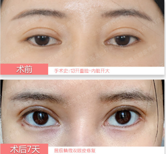 深圳哪家公立三甲医院医生做双眼皮/双眼皮修复好？
