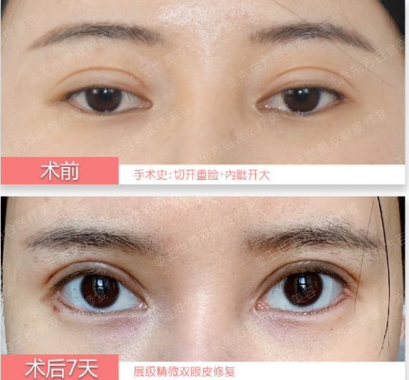 深圳哪家公立三甲医院医生做双眼皮/双眼皮修复好?