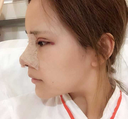 花了4万多在北京做的鼻部手术和眼部手术。