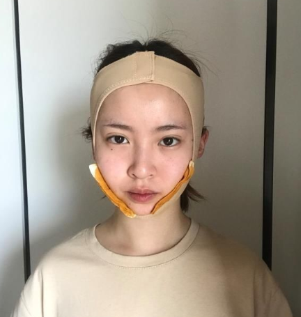 跑到上海做了下颌角手术真的太美了吧!