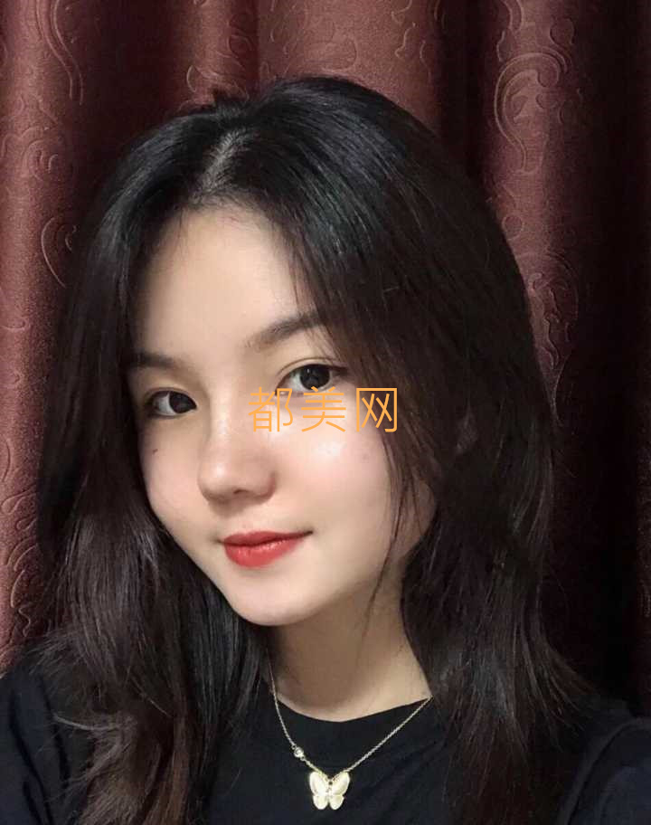 分享我在郑州做的隆鼻,不说惊艳但是也很好看了!