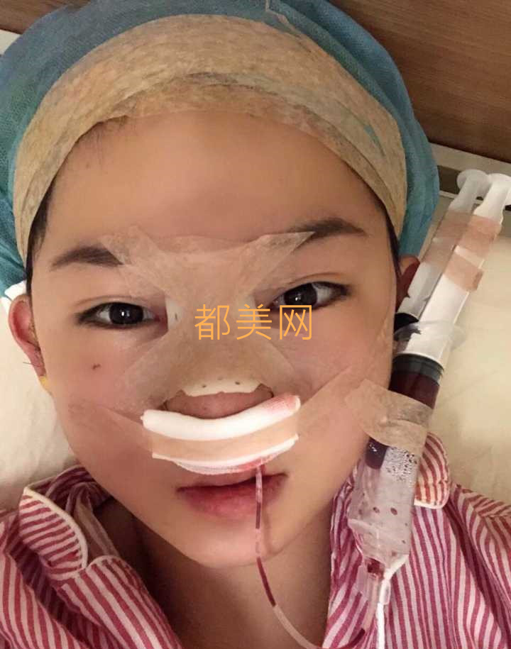 分享我在郑州做的隆鼻,不说惊艳但是也很好看了!