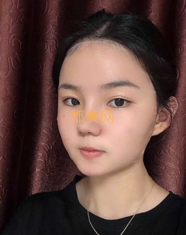 分享我在郑州做的隆鼻,不说惊艳但是也很好看了!