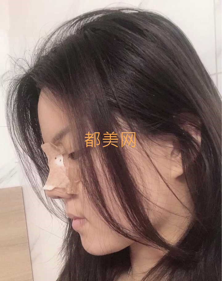 分享我在郑州做的隆鼻,不说惊艳但是也很好看了!