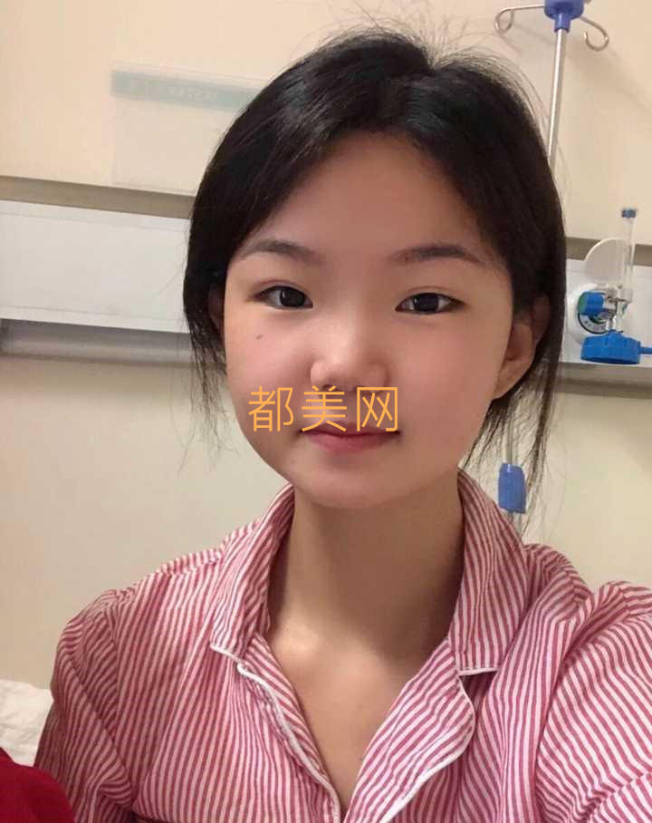 分享我在郑州做的隆鼻,不说惊艳但是也很好看了!