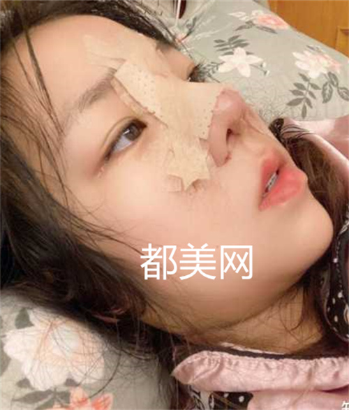 重庆隆鼻没有做缩小鼻翼也很好看,妈生鼻。