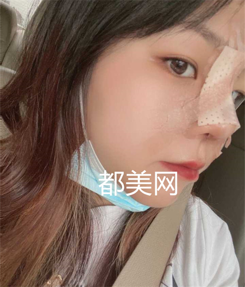重庆隆鼻没有做缩小鼻翼也很好看,妈生鼻。