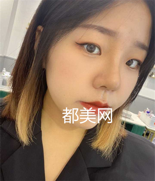 重庆隆鼻没有做缩小鼻翼也很好看,妈生鼻。