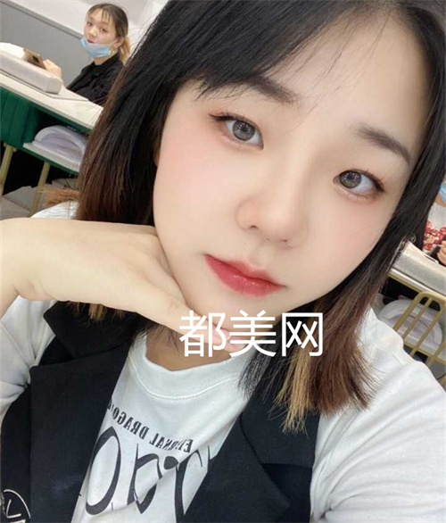 重庆隆鼻没有做缩小鼻翼也很好看,妈生鼻。