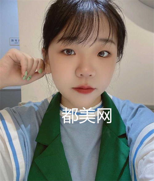 重庆隆鼻没有做缩小鼻翼也很好看,妈生鼻。