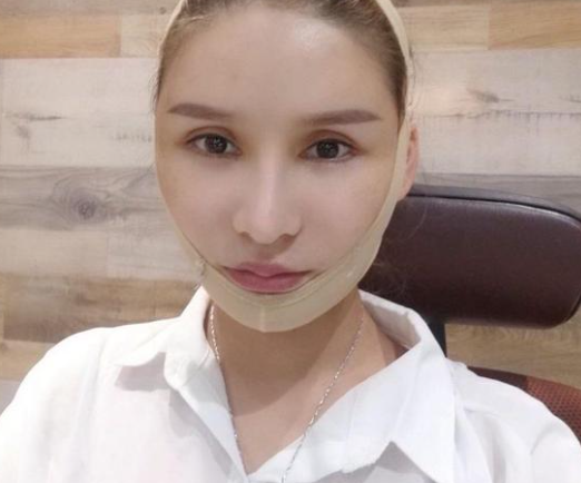 分享我的拉皮手术经历,姐妹们你们就说这个做得值不值吧?