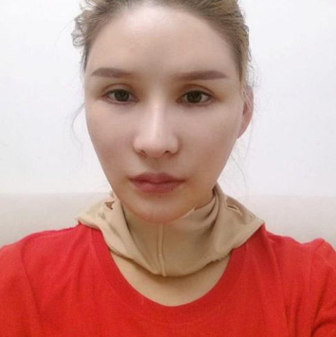 分享我的拉皮手术经历,姐妹们你们就说这个做得值不值吧?