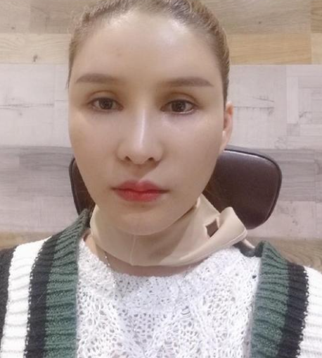 分享我的拉皮手术经历,姐妹们你们就说这个做得值不值吧?